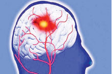 برخی مطالعات نشان داده کرونا باعث سکته مغزی می‌شود