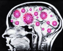 ویروس کرونا بعد از بهبودی بیمار  در مغز باقی می ماند