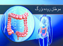 سرطان روده بزرگ در رتبه دوم سرطان های مرگبار