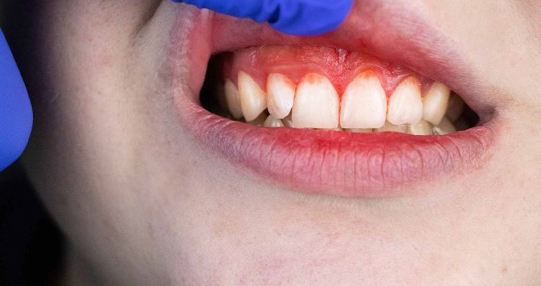عفونت دندان و لثه چه بیماری‌هایی  به دنبال دارد