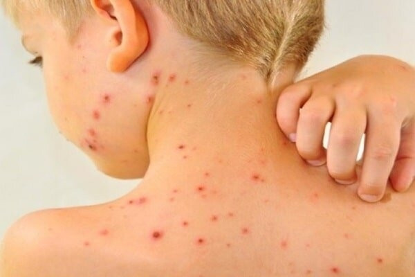 بالاترین میزان موارد ابتلا به سرخک  در آمریکا از سال ۲۰۰۰ تاکنون