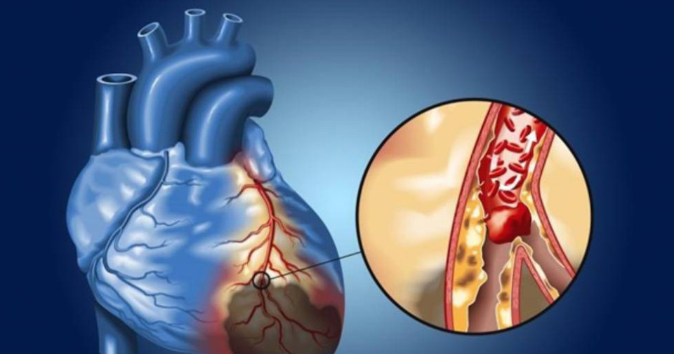 پیشگیری طبیعی از گرفتگی عروق قلب