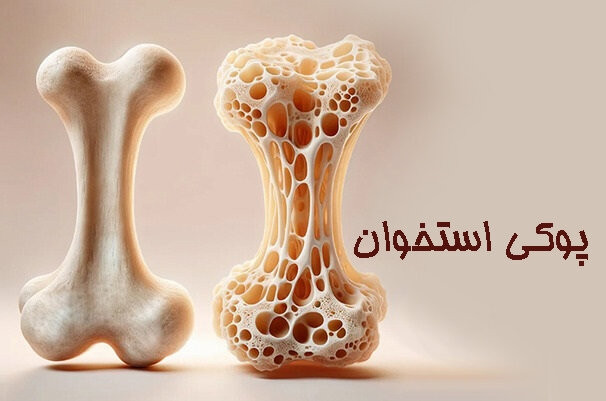 این علائم یعنی استخوان‌های شما در حال پوک شدن است!