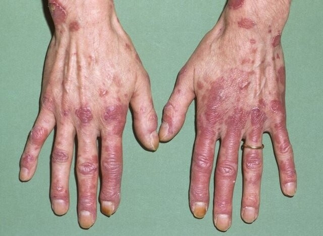 لوپوس؛ بیماری خودایمنی مزمن و ناتوان‌کننده