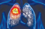 غربالگری سی تی اسکن موجب بهبود عوارض سرطان ریه می شود