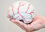 موارد سکته مغزی به عنوان یک قاتل جهانی در حال افزایش است