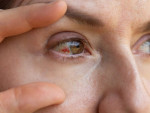 دلایل پارگی رگ خونی در چشم؛  چه موقع باید به پزشک مراجعه کنیم؟